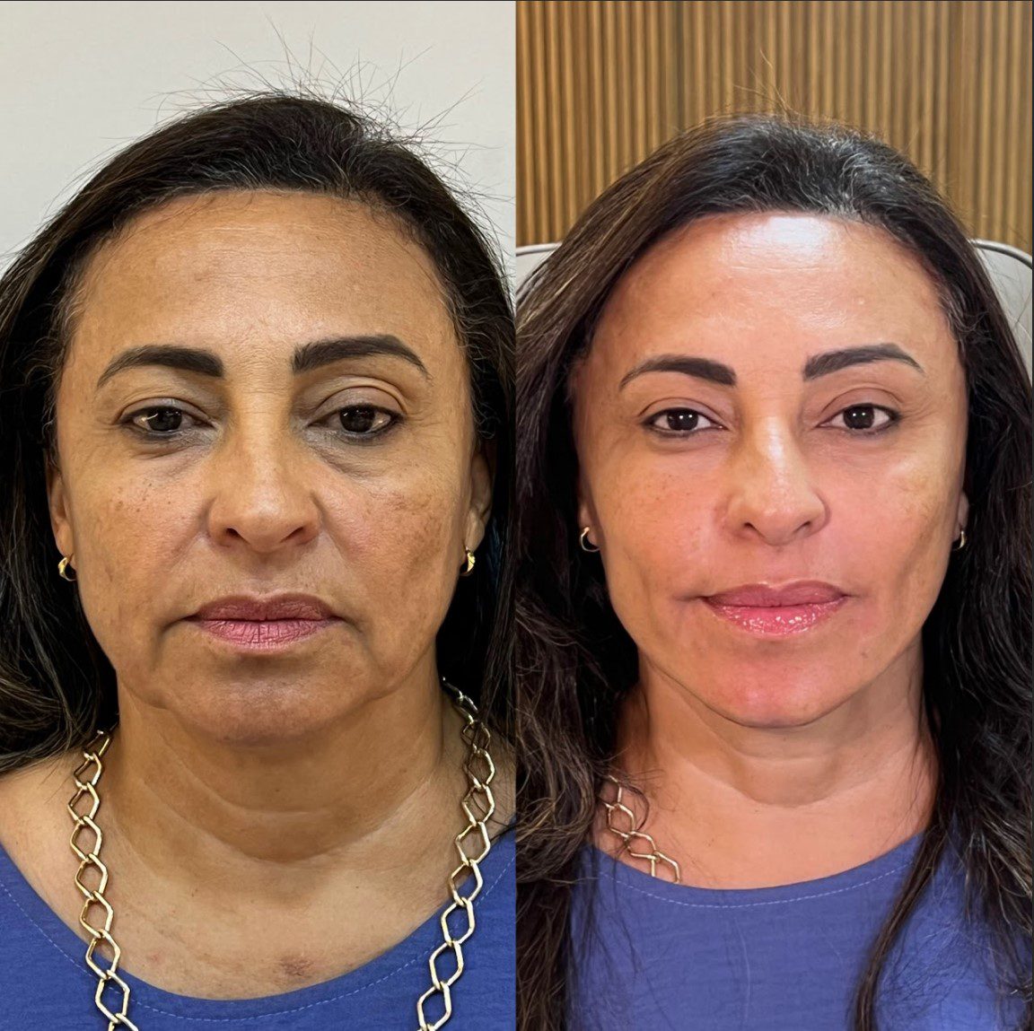 Caso 1 - rosto de frente, antes e depois