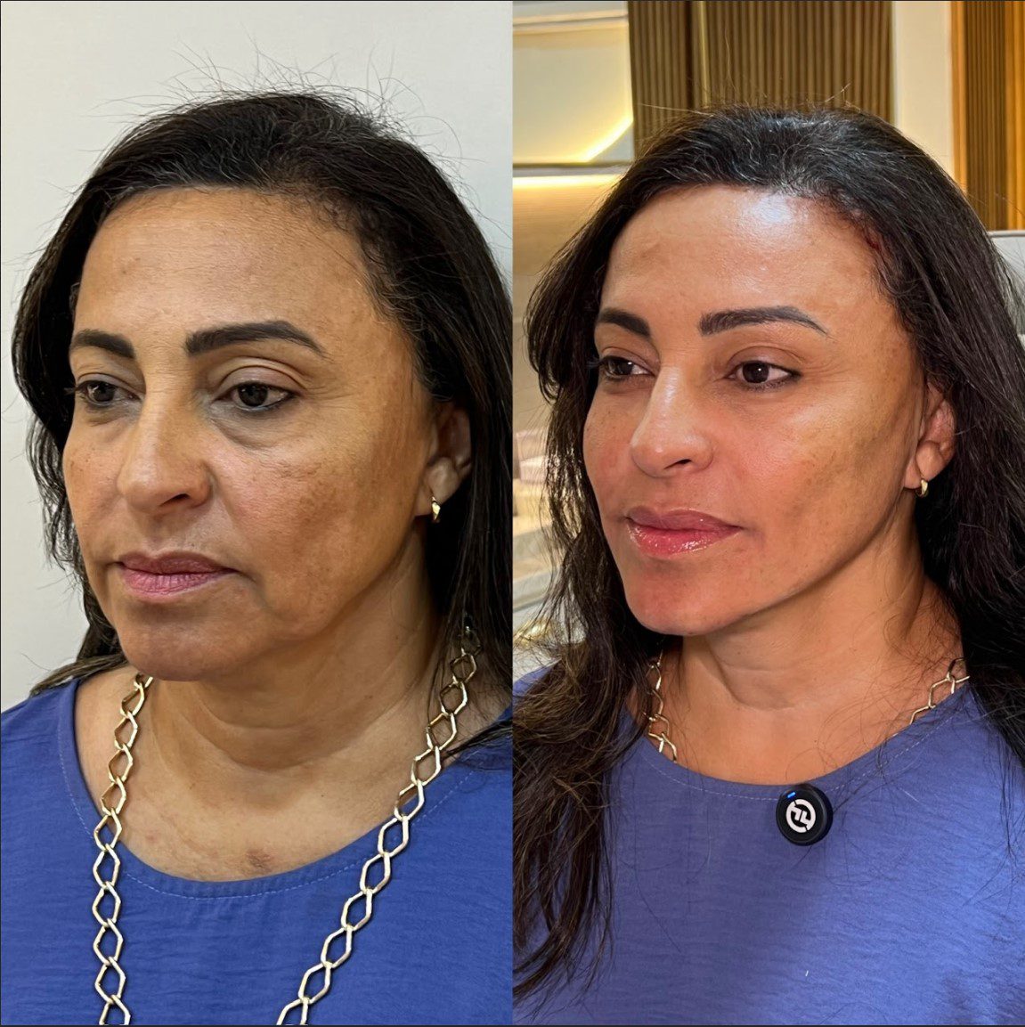 Caso 1 - perfil direito, antes e depois