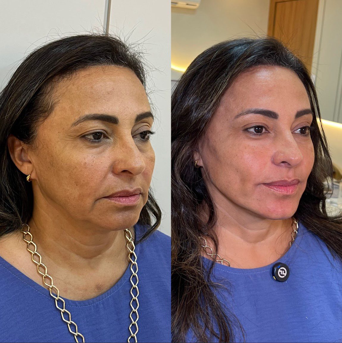 Caso 1 - perfil esquerdo, antes e depois