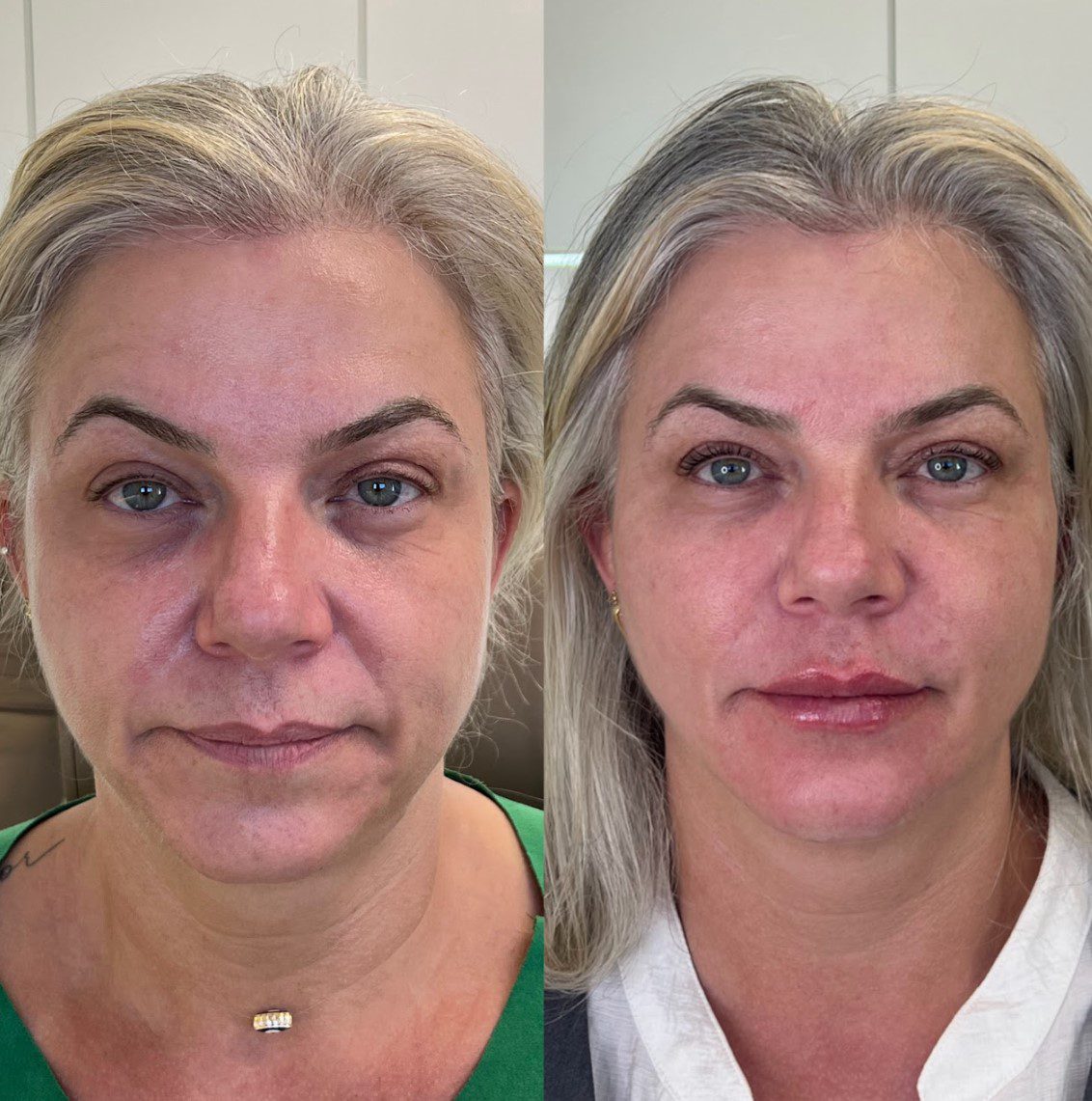 Caso 2 - rosto de frente, antes e depois