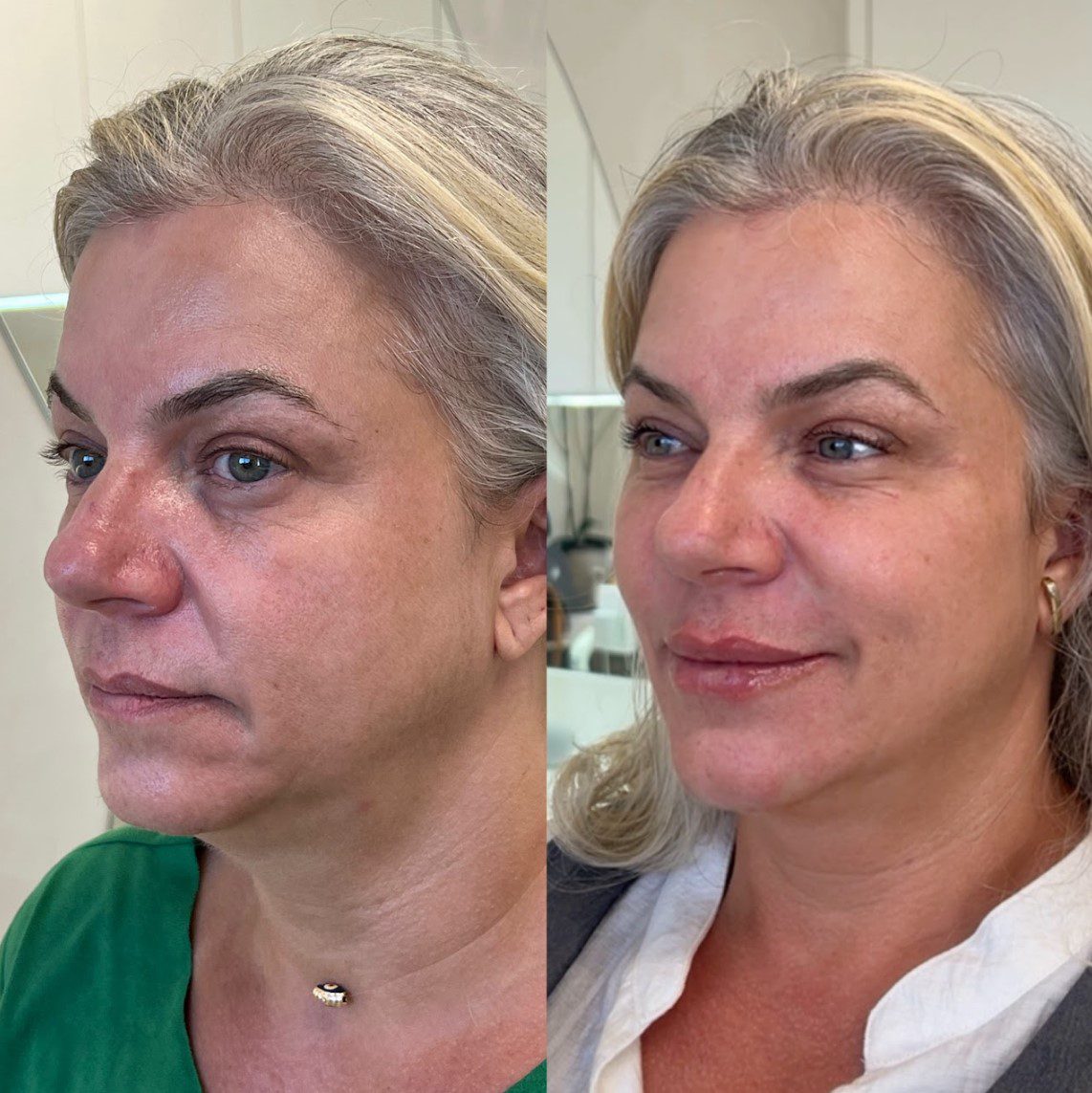 Caso 2 - perfil direito, antes e depois