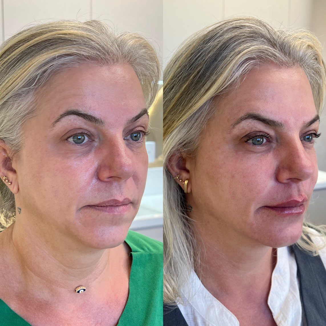 Caso 2 - perfil esquerdo, antes e depois