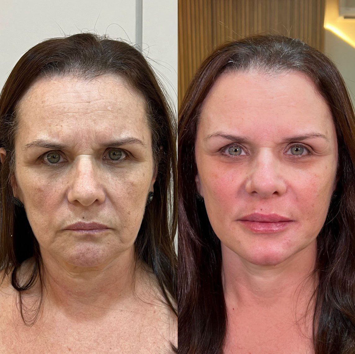 Caso 3 - rosto de frente, antes e depois
