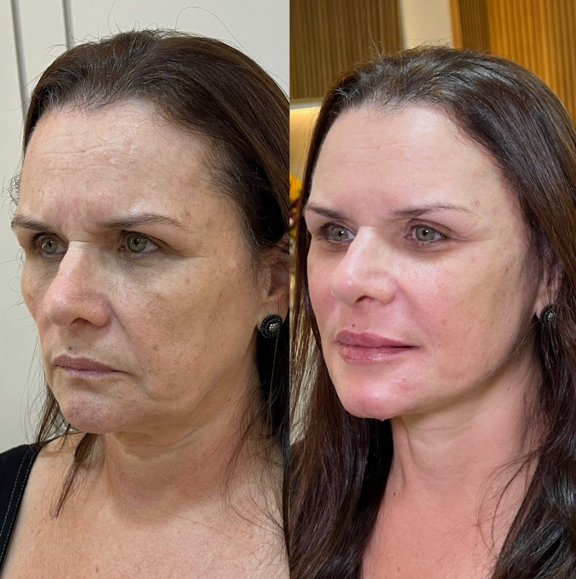 Caso 3 - perfil direito, antes e depois