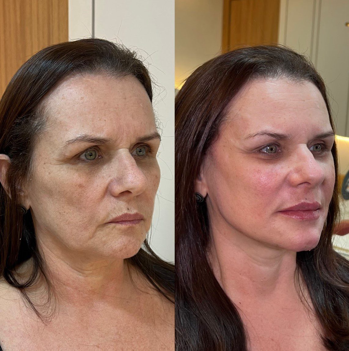 Caso 3 - perfil esquerdo, antes e depois