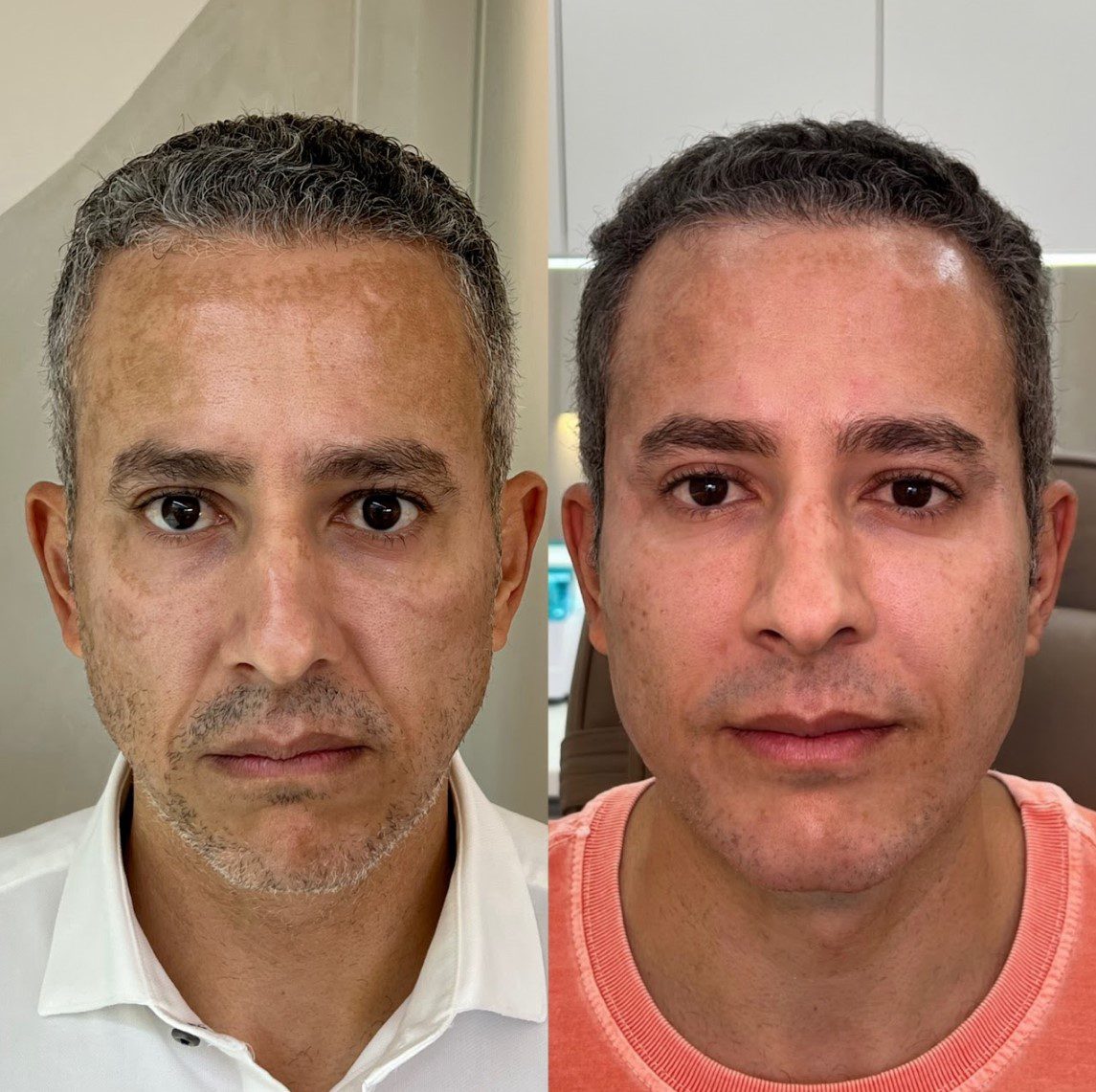 Caso 4 - rosto de frente, antes e depois