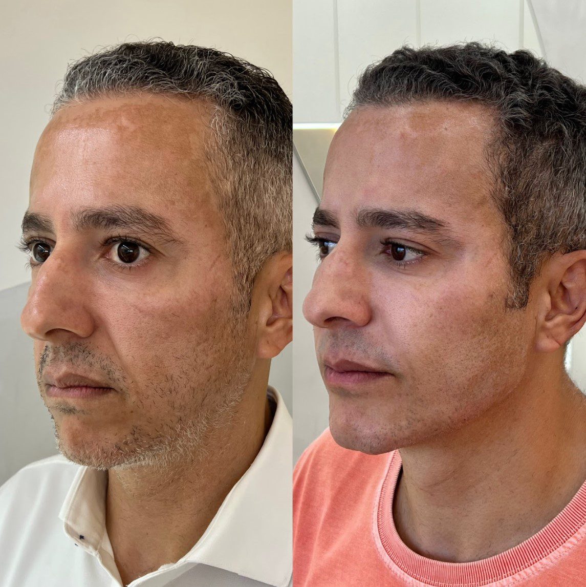 Caso 4 - perfil direito, antes e depois