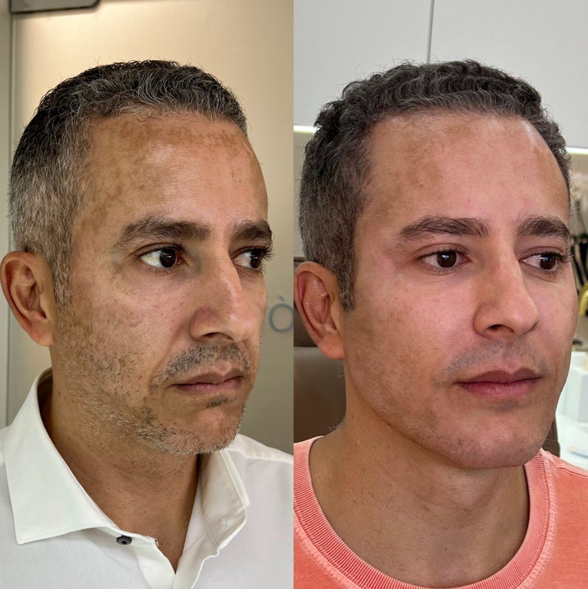 Caso 4 - perfil esquerdo, antes e depois