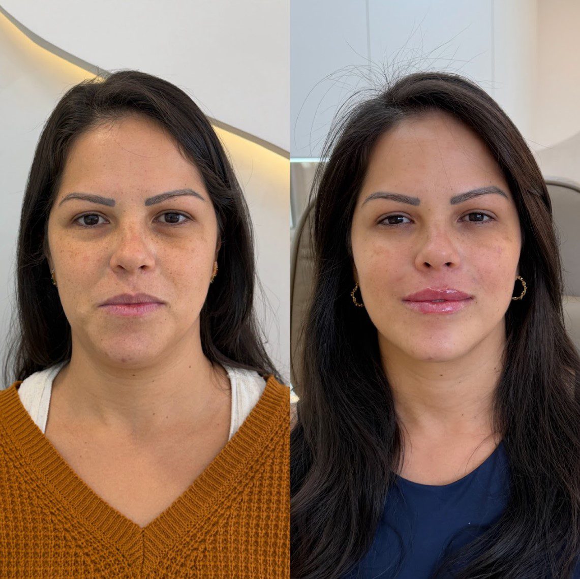 Caso 5 - rosto de frente, antes e depois