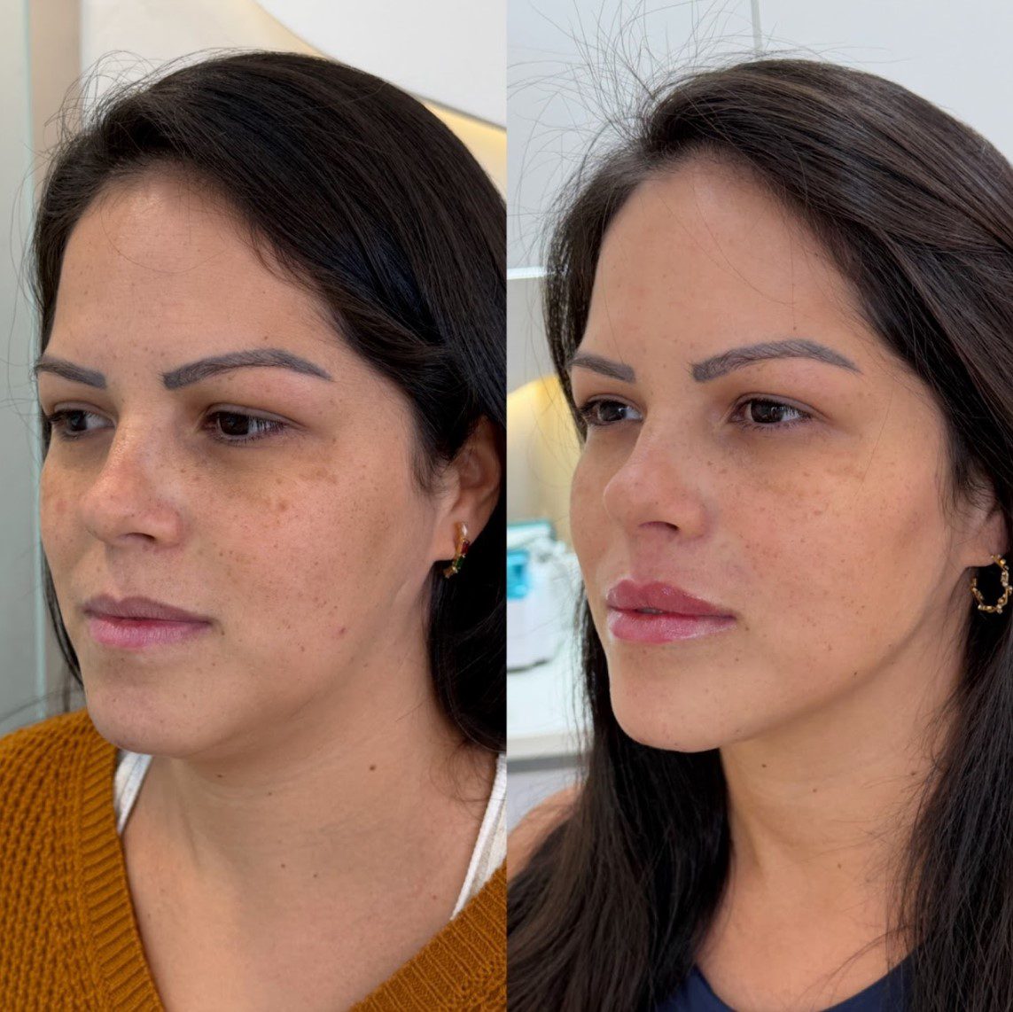 Caso 5 - perfil direito, antes e depois