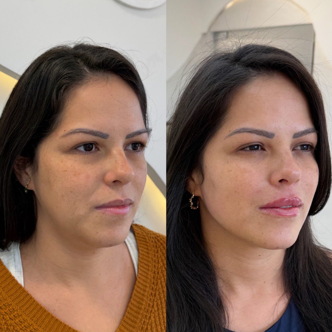 Caso 5 - perfil esquerdo, antes e depois