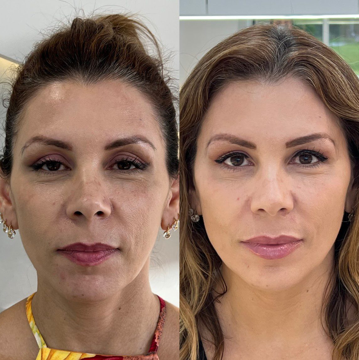 Caso 6 - rosto de frente, antes e depois