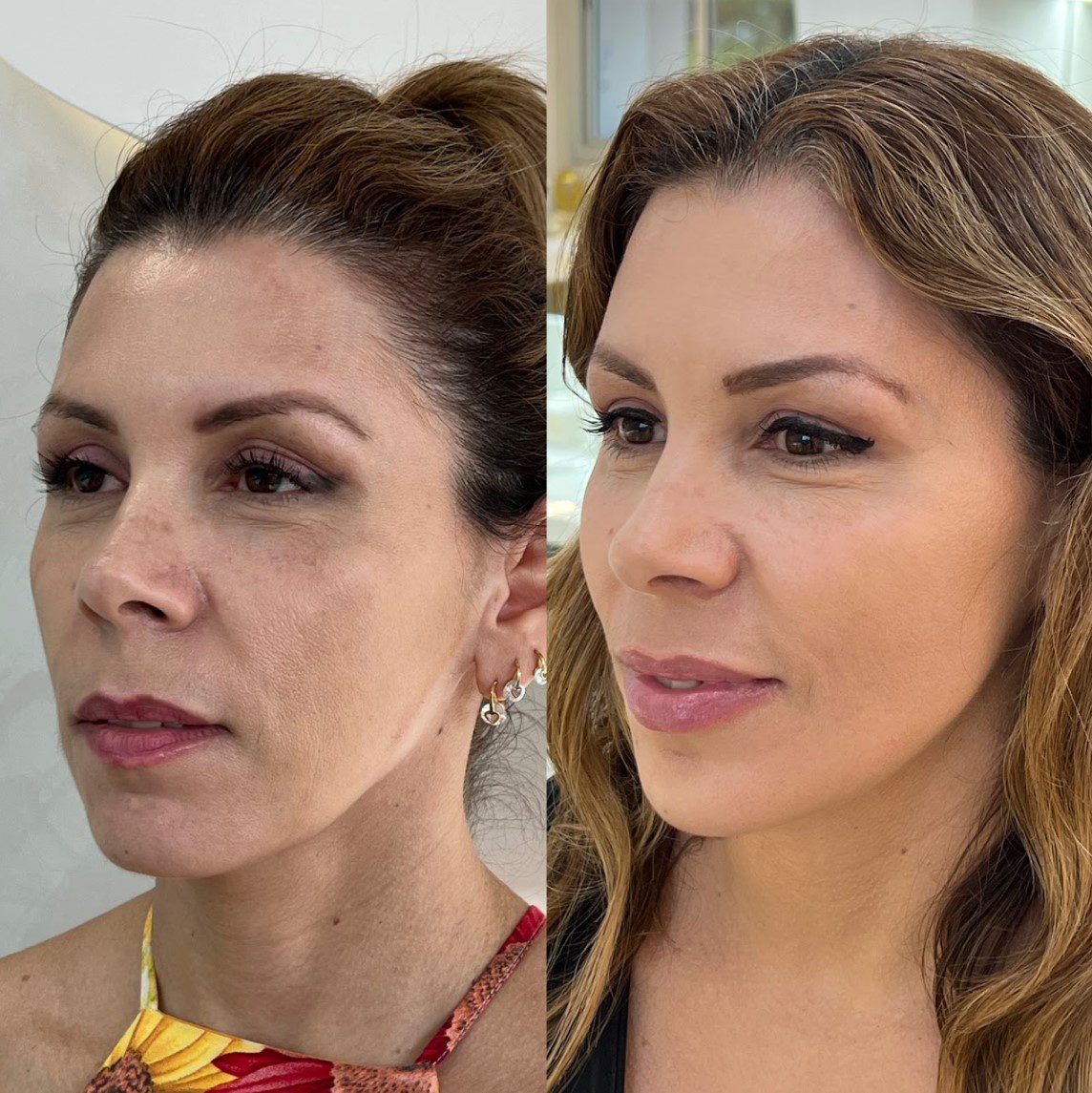 Caso 6 - perfil direito, antes e depois