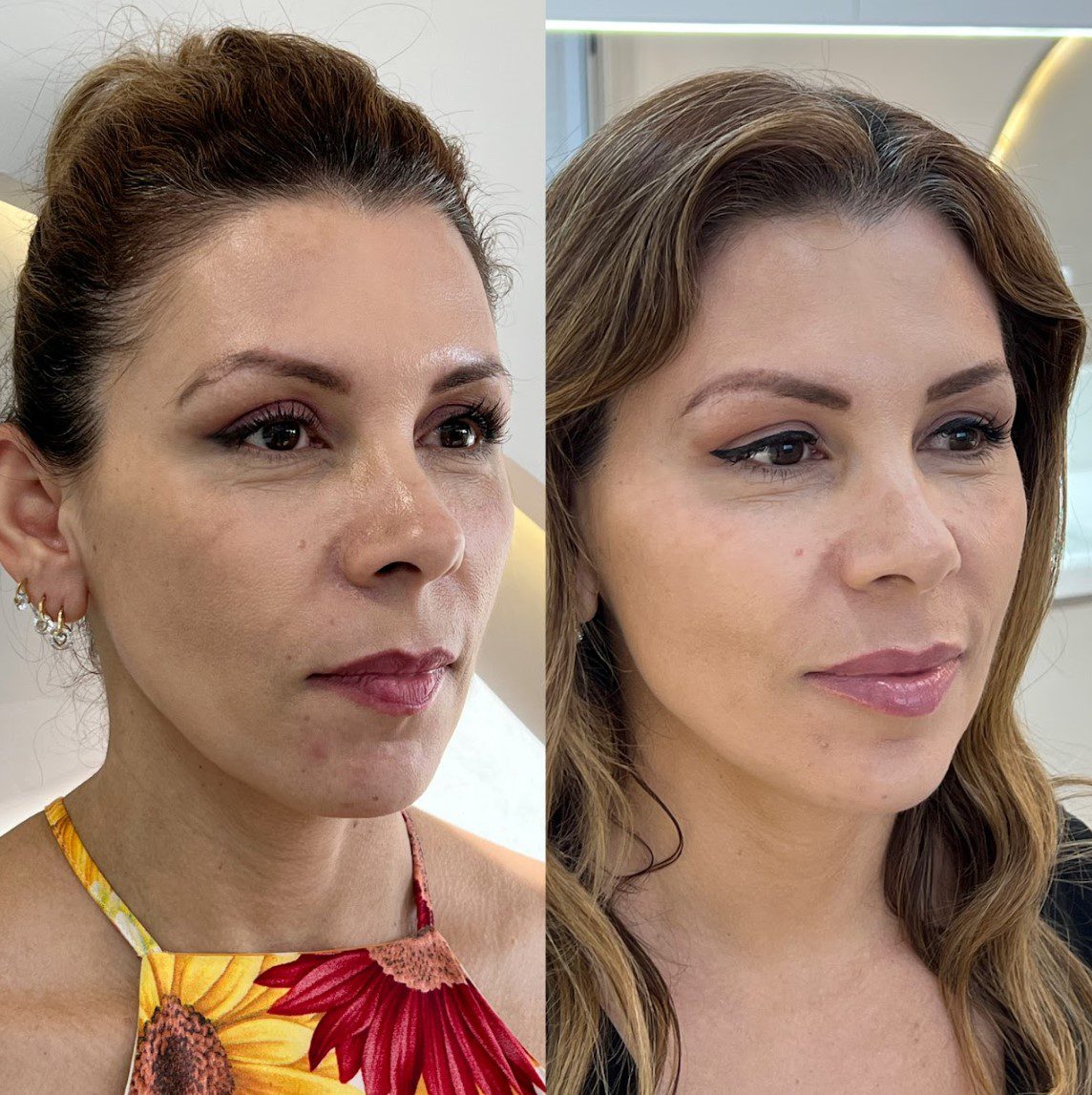 Caso 6 - perfil esquerdo, antes e depois