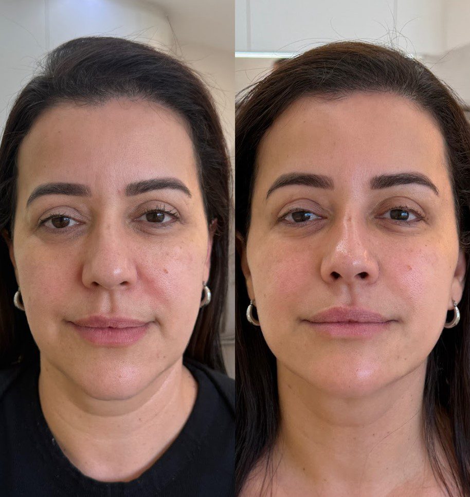 Caso 7 - rosto de frente, antes e depois