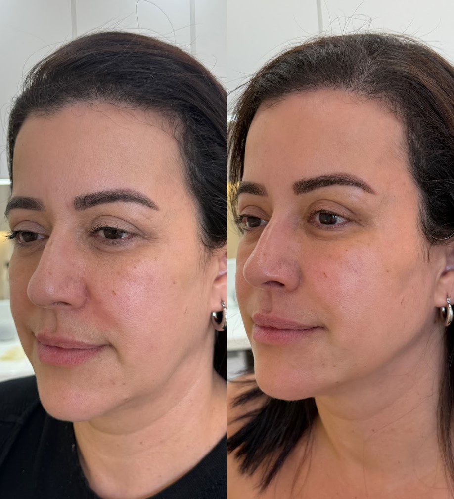 Caso 7 - perfil direito, antes e depois