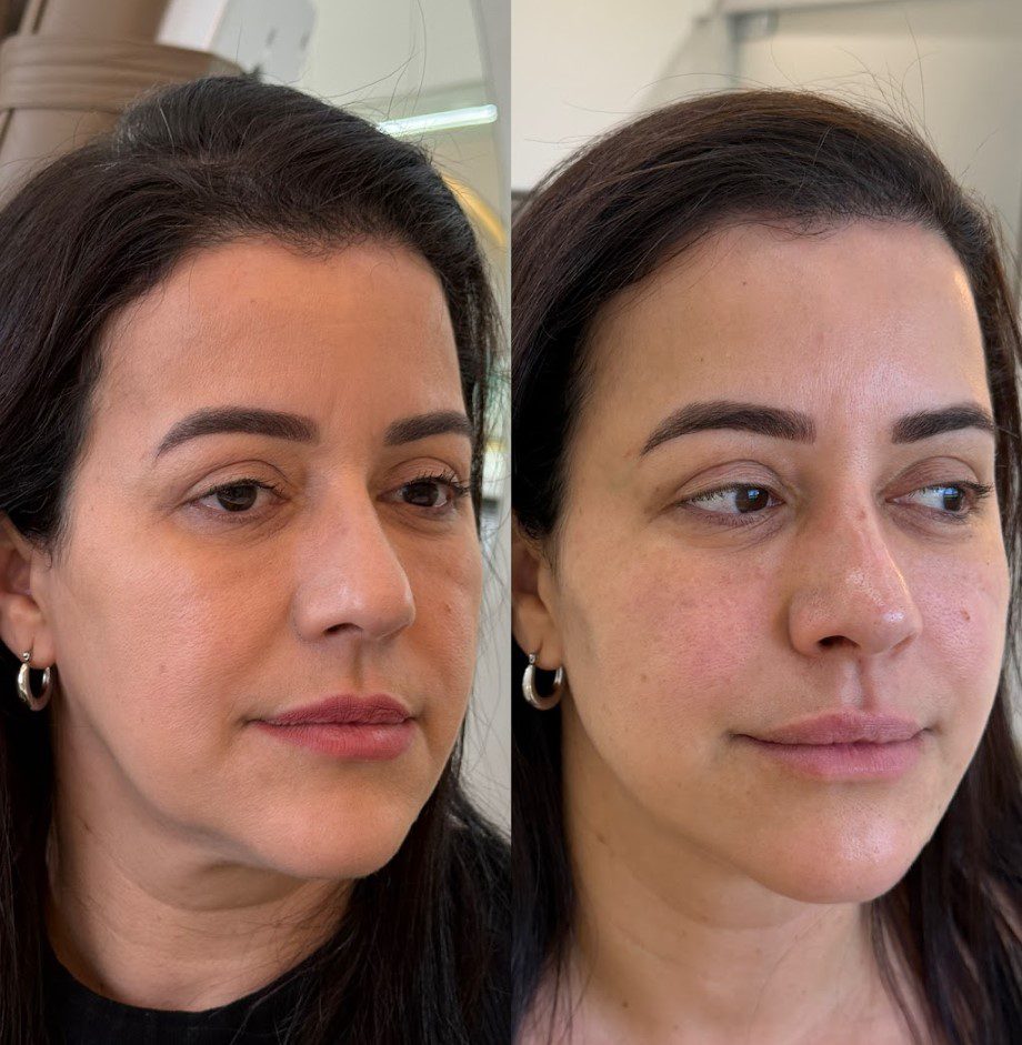 Caso 7 - perfil esquerdo, antes e depois