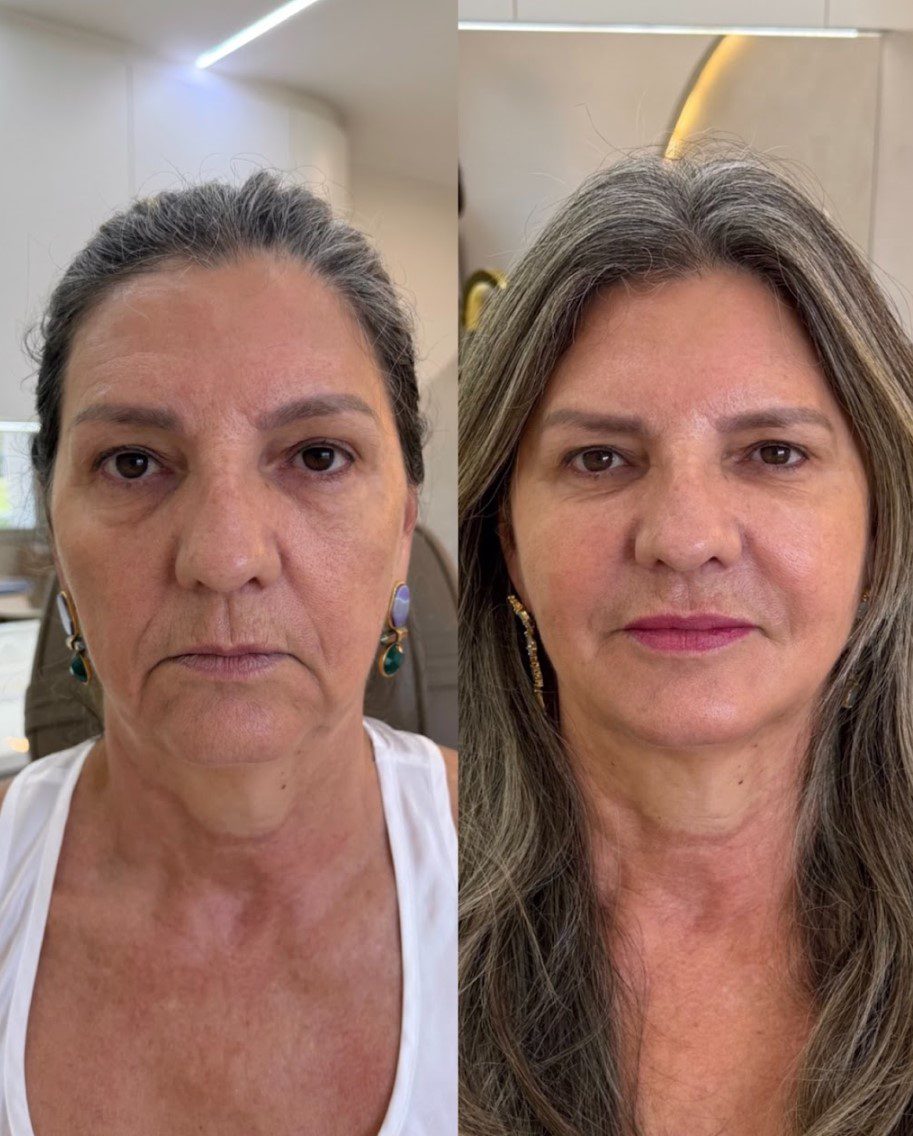 Nova paciente — resultado de frente 4